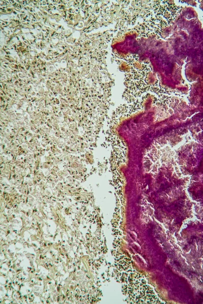 Choroba Actinomyces Pod Mikroskopem 100X — Zdjęcie stockowe