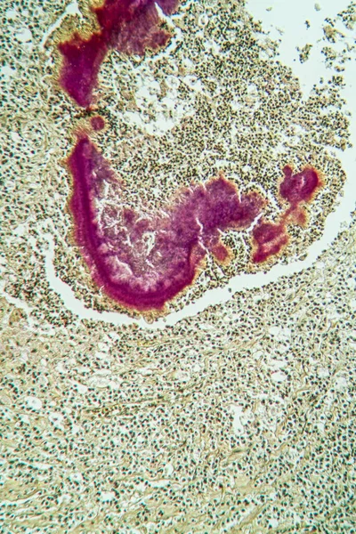 Choroba Actinomyces Pod Mikroskopem 100X — Zdjęcie stockowe