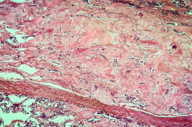 Tiroit bezinin karışık tümörü. Hastalıklı doku 100 kat.