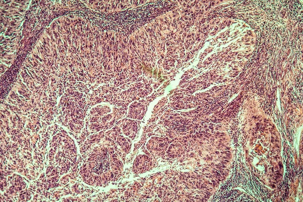 Cancer Utérus Tissu Malade 100X — Photo