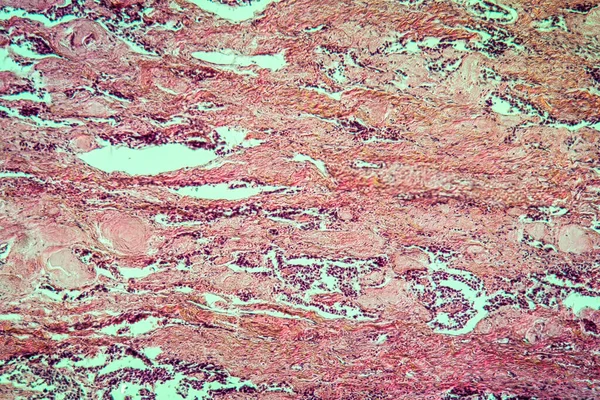 Tumor Misto Glândula Tireóide Tecido Doente 100X — Fotografia de Stock