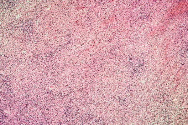 Ganglions Lymphatiques Cancer Tissu Malade 100X — Photo