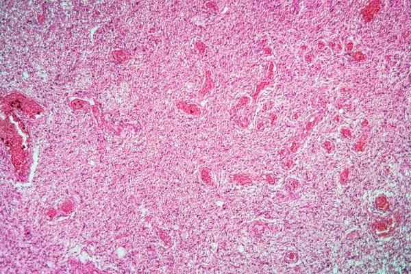 Tumor Glioma Con Tejido Enfermo 100X — Foto de Stock