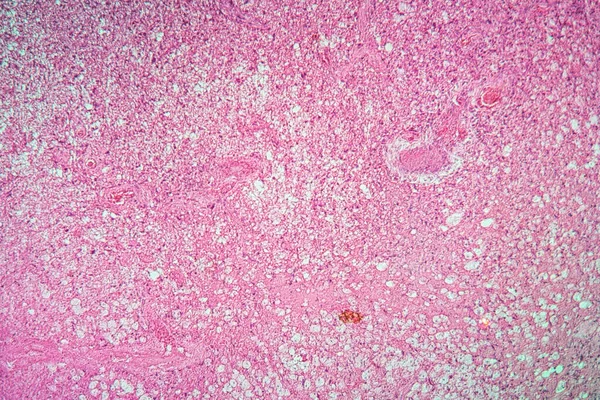 Glioma Tumor Com Tecido Doente 100X — Fotografia de Stock