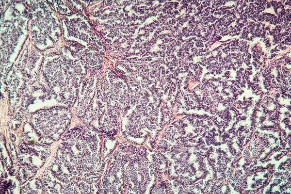 Metastases tumor diseased tissue 100x