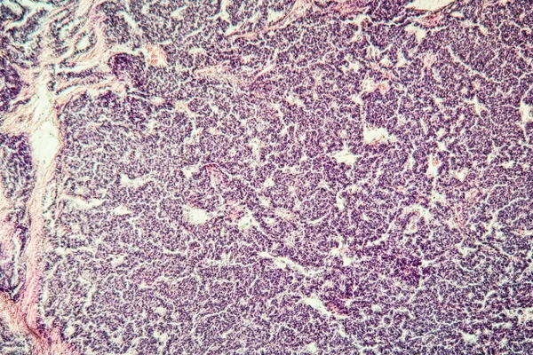 Metastasi Tumore Tessuto Malato 100X — Foto Stock