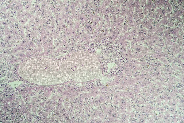 schistosomiasis képek