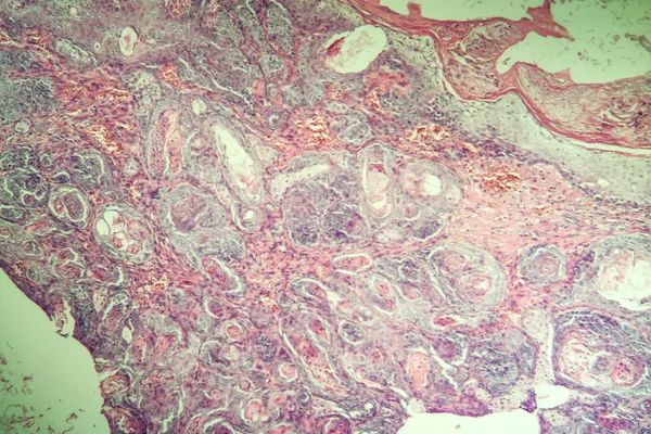 Carcinoma Nelle Cavie Tessuto 100X — Foto Stock