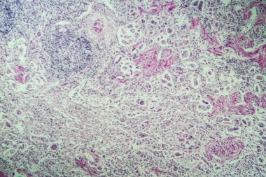 Mikroskop altında akciğer kurdu.