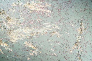 Böbrek dokusunda gut kristalleri var. Mikroskop altında.