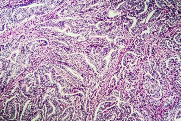 Gastric carcinoma in tissue section 100x