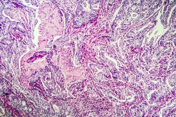 Carcinoma Gastrico Nella Sezione Tissutale 100X — Foto Stock