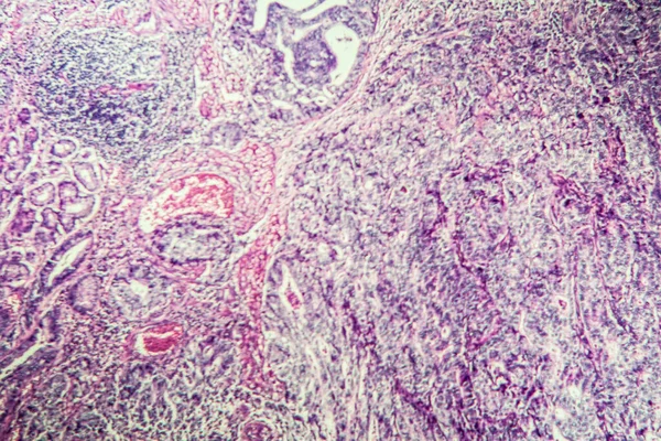 Gastric Carcinoma Tissue Section 100X — Stock Photo, Image