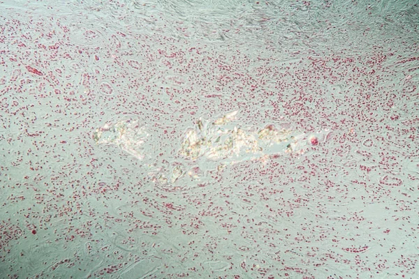 100X显微镜下肾组织中的痛风晶体沉积 — 图库照片