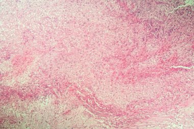 Mikroskop altında safra kesesi nekrozu dokusu 100x