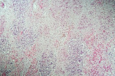 Tüberküloz yapraklarla zehirlendikten sonra karaciğer dokusu hastalığına yakalanmış. 100 kat mantar.