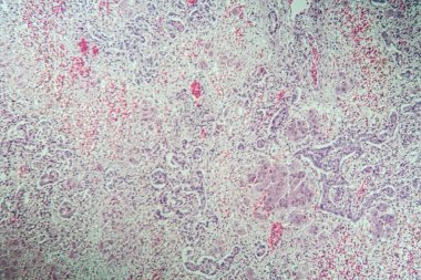 Tüberküloz yapraklarla zehirlendikten sonra karaciğer dokusu hastalığına yakalanmış. 100 kat mantar.