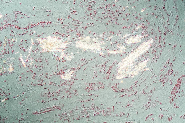 100X显微镜下肾组织中的痛风晶体沉积 — 图库照片