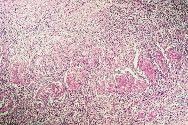 Tessuto Necrosi Della Cistifellea Microscopio 100X — Foto Stock