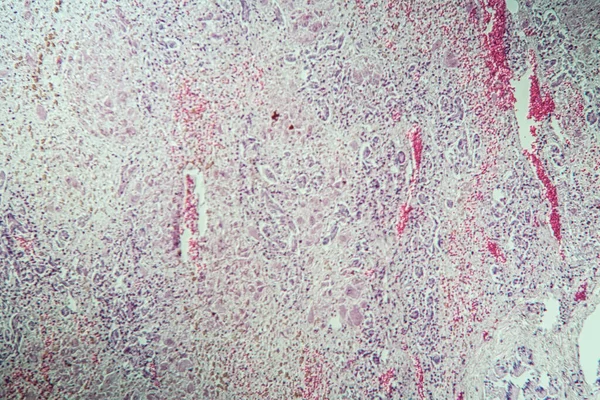 Diseased liver tissue after poisoning with tuberous leaves mushroom 100x