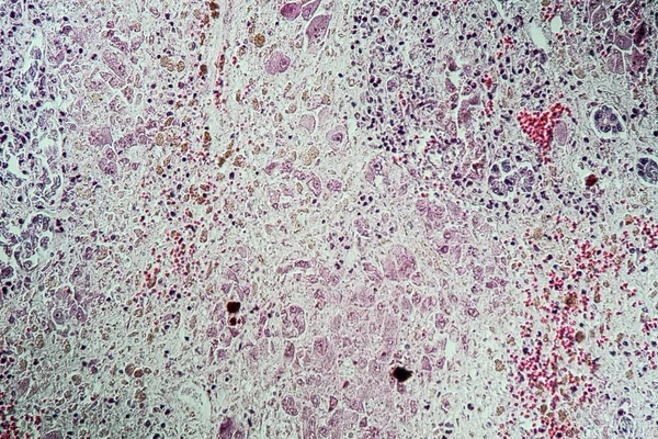 Diseased liver tissue after poisoning with tuberous leaves mushroom 200x