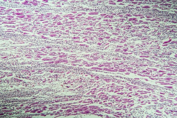 Inflammation Muscle Cardiaque Comme Myocardite 100X — Photo