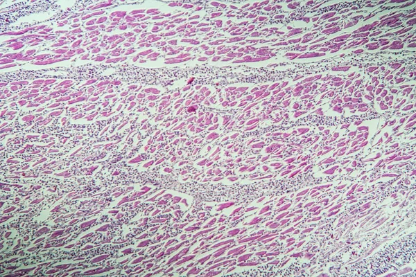 Inflammation Muscle Cardiaque Comme Myocardite 100X — Photo