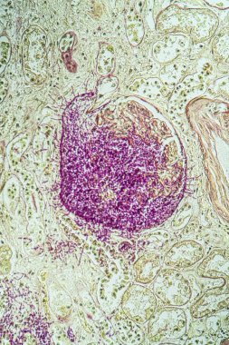 Candida mantarlı AIDS dokusu 200x büyüyor.