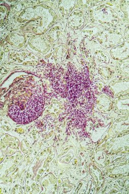 Candida mantarlı AIDS dokusu 200x büyüyor.