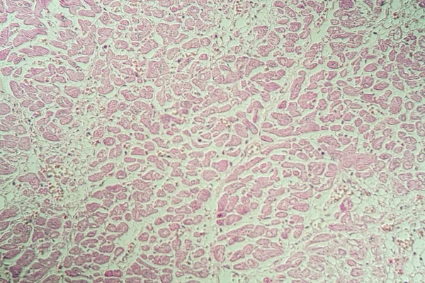 Tecido Doente Inflamado Músculo Cardíaco Sob Microscópio 200X — Fotografia de Stock