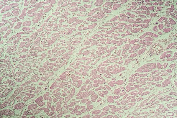 Воспаленная Сердечная Мышца Больная Ткань Микроскопом 200X — стоковое фото