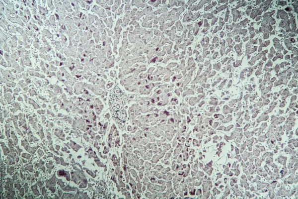 Marcador Hepatitis Del Tejido Enfermo Bajo Microscopio 100X — Foto de Stock