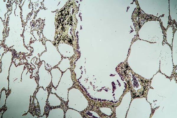 Astma Der Lunge Krankes Gewebe Unter Dem Mikroskop 100X — Stock fotografie