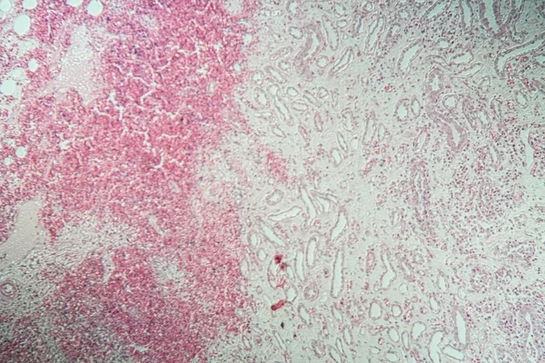 Nefritis Polivalente Tejido Bajo Microscopio 100X — Foto de Stock