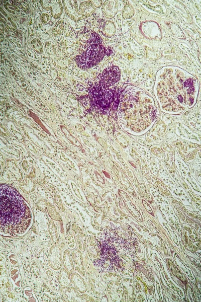 Aids Tissue Fungus Candida Grow 100X — Stock Photo, Image