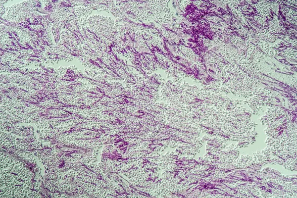 Infección Pulmonar Por Candida Aspergillus Pacientes Con Sida 200X —  Fotos de Stock