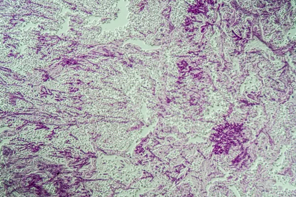 Poumons Infection Par Candida Aspergillus Chez Les Patients Atteints Sida — Photo