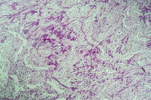 Инфекция Легких Кандидой Аспергиллусом Больных Спидом 200X — стоковое фото