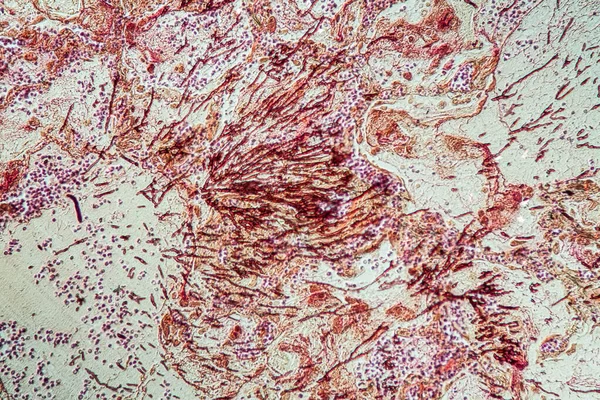 Infecção Pulmonar Por Candida Aspergillus Doentes Com Sida 200X — Fotografia de Stock