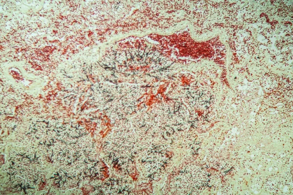 200X艾滋病患者肺部感染念珠菌和曲菌的研究 — 图库照片
