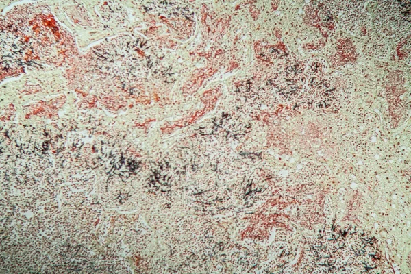 Зараження Легенів Кандідою Аспергіллом Хворих Снід 200X — стокове фото