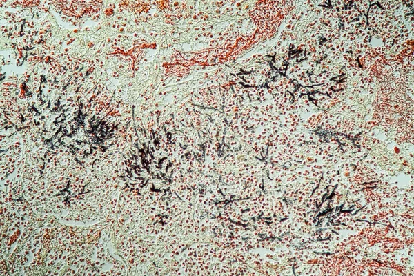 Aids Hastalarında Akciğer Enfeksiyonu Candida Aspergillus 200 — Stok fotoğraf
