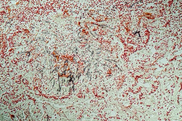 Aids Hastalarında Akciğer Enfeksiyonu Candida Aspergillus 200 — Stok fotoğraf