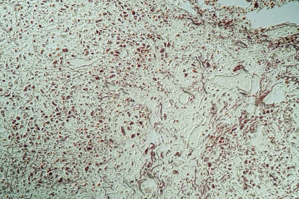 200X艾滋病患者肺部感染念珠菌和曲菌的研究 — 图库照片