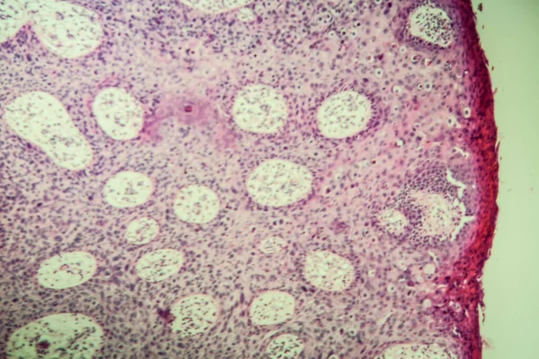 Bowens Sjukdom Tumör Mikroskop 100X — Stockfoto