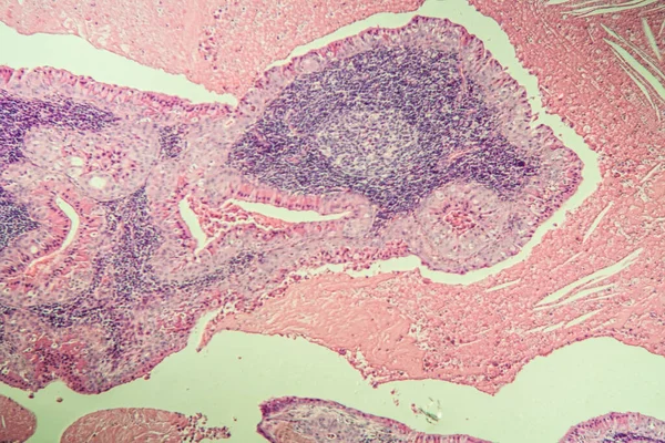 Glande Salivaire Tissu Malade Gonflé Sous Microscope 100X — Photo