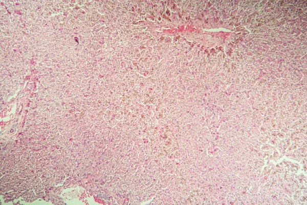 Billirubin Liver Disease Microscope 100X — 图库照片