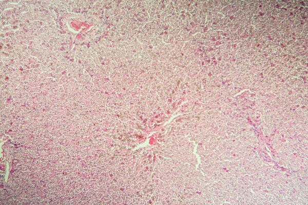 Billirubin Liver Disease Microscope 100X — 스톡 사진