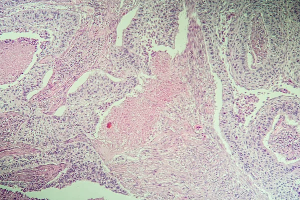 Squamous cell carcinoma diseased tissue under the microscope 100x