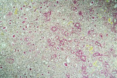 Mikroskop altında küçülmüş böbrek hastalıklı doku 100 kat